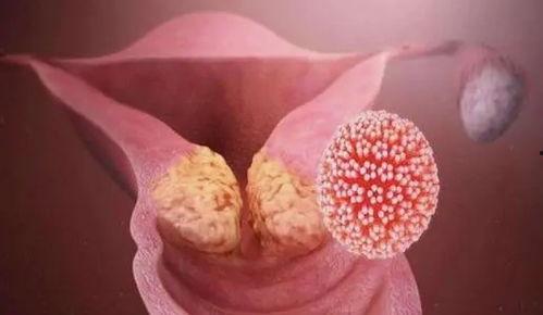 感染hpv吃瓜,揭秘病毒与“吃瓜”之间的微妙关系
